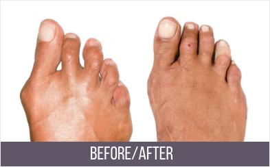 best bunion doctor near me