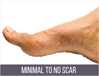 bunion surgery before after 2