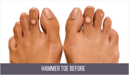 Hammertoe Surgery NYC | Hammertoe Treatment Specialist Manhattan