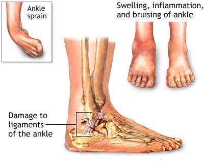 Ankle Sprains 