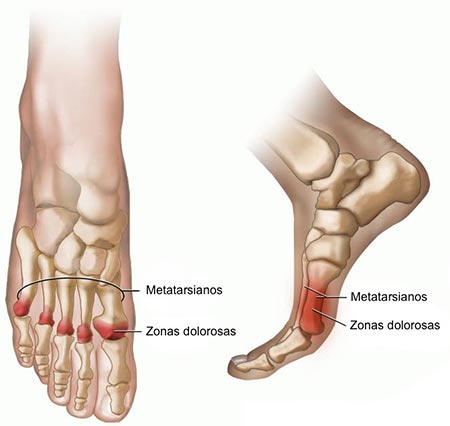 heel pain ball of foot