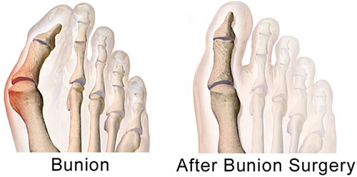 Bunion Surgery NYC | Minimally Invasive Bunion Removal in New York City