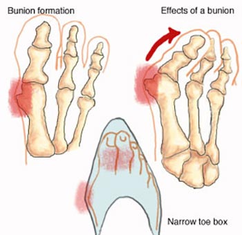 bunions corns calluses