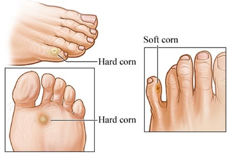 corn on foot toe