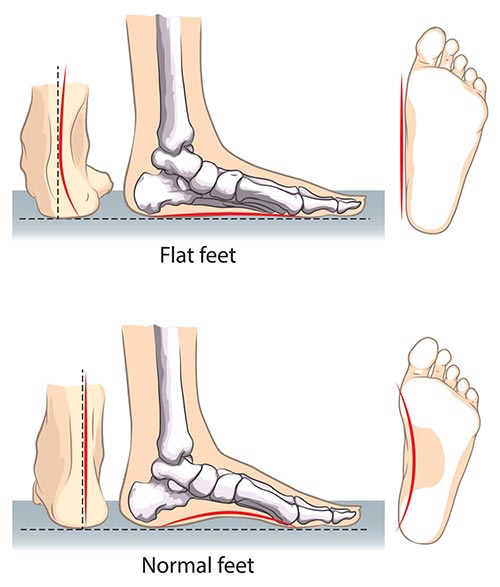 flat foot wearing heels