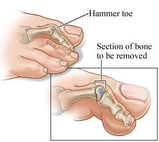 Hammer Toe Surgery | Midtown Manhattan NY