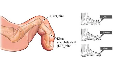 Hammertoes Treatment Manhattan