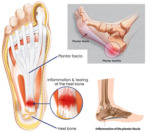 heel hurts to walk on