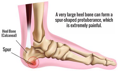 bone spurs in feet