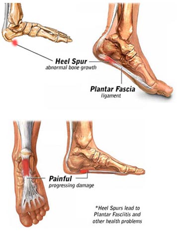 bone spurs in feet