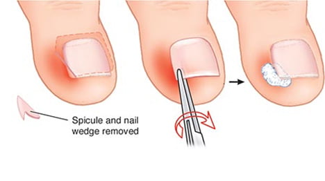 Ingrown Toenail Removal