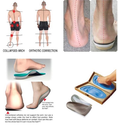 Do Arch Supports Help Ankle Pain? - Foot and Ankle Surgeons of New York