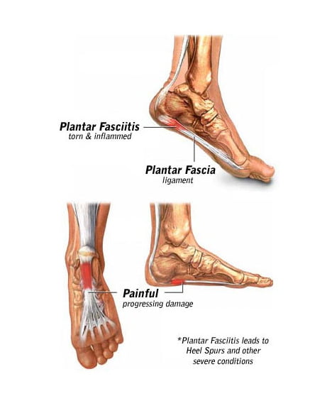 walking boot for torn plantar fascia