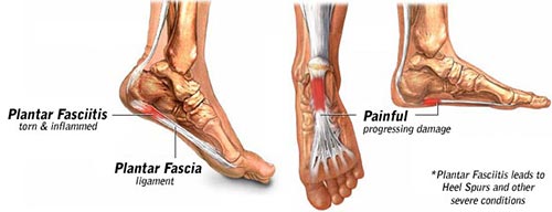 Plantar Fasciitis in | Endoscopic Plantar Fasciotomy