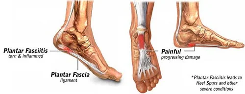 The plantar fascia is a thick band of connective tissue that supports