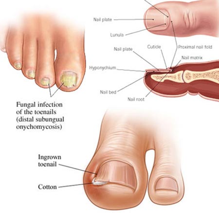 Toenail Fungus Treatment In Nyc Manhattan Foot Specialists