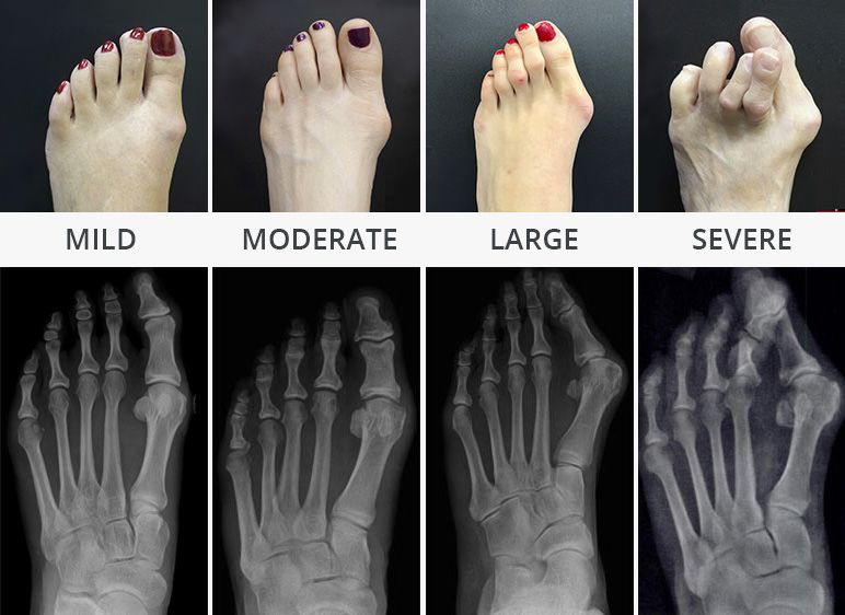 Bunions (Hallux Valgus) Deformity Stages