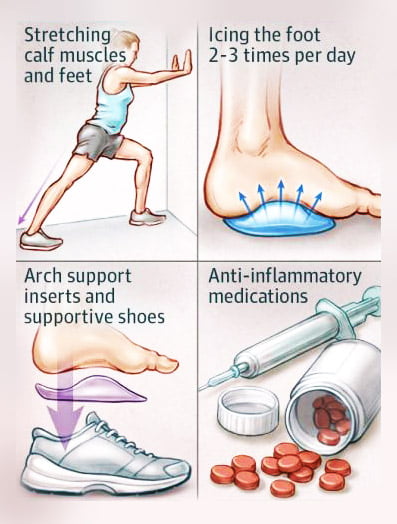 what to do for plantar fasciitis