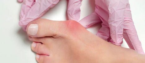 bunions corns calluses