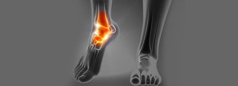 Ankle pain condition