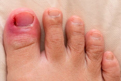 ingrown toenail spur