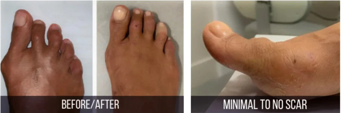 bunion surgery in nyc | before after