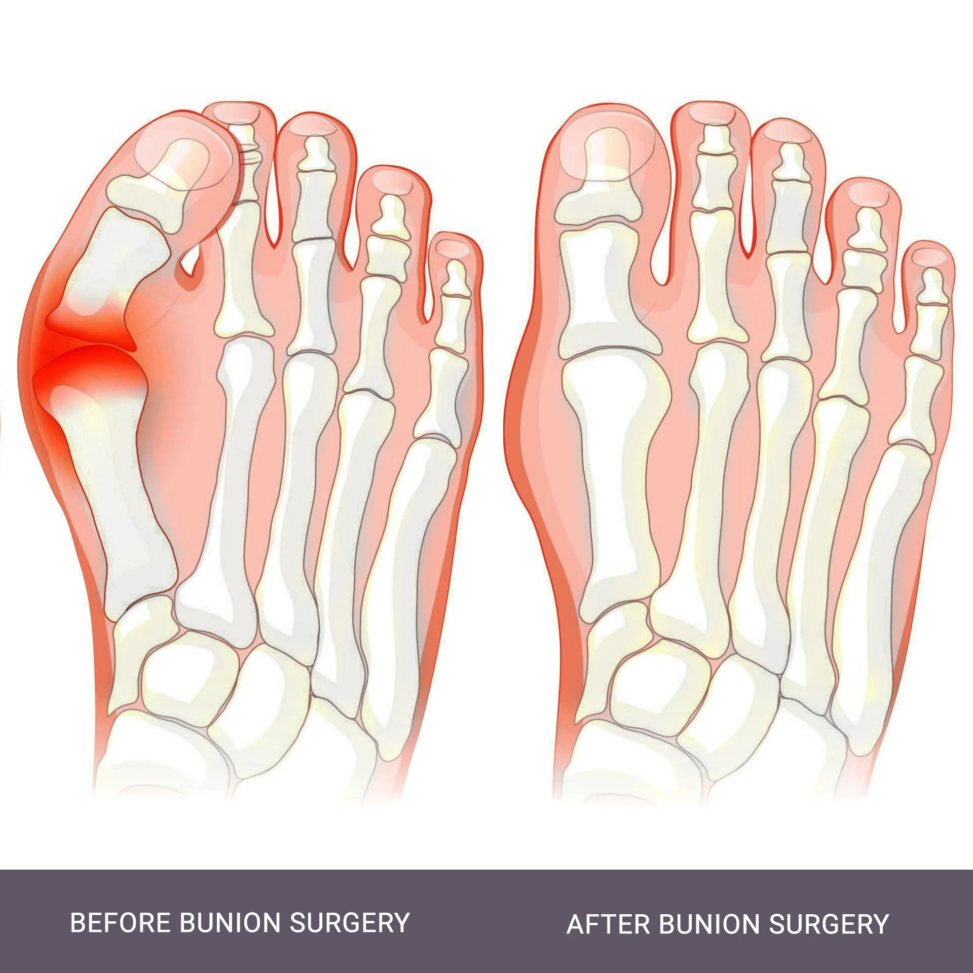 Bunion Surgery NYC
